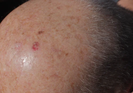 Actinic Keratosis 2 Trillium Clinic Dermatology Chapel Hill