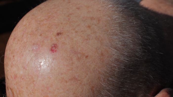 Actinic Keratosis 2 Trillium Clinic Dermatology Chapel Hill