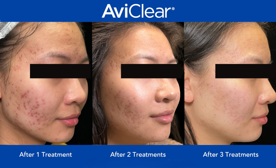 AviClear1 Trillium Clinic Dermatology Chapel Hill