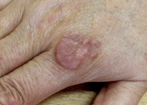 Granuloma Annulare scaled 1 Trillium Clinic Dermatology Chapel Hill