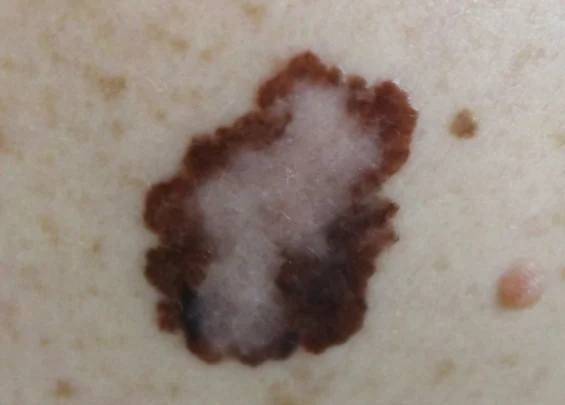 Melanoma 1 scaled 1 Trillium Clinic Dermatology Chapel Hill