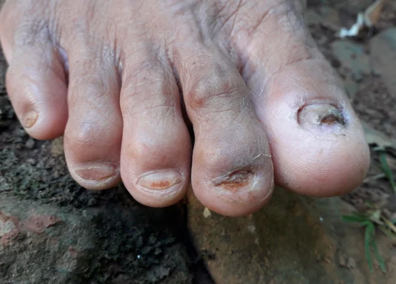 Onychomycosis scaled 1 Trillium Clinic Dermatology Chapel Hill