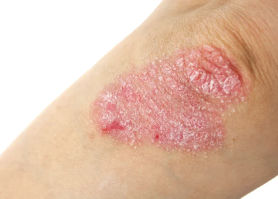 Psoriasis scaled 1 Trillium Clinic Dermatology Chapel Hill