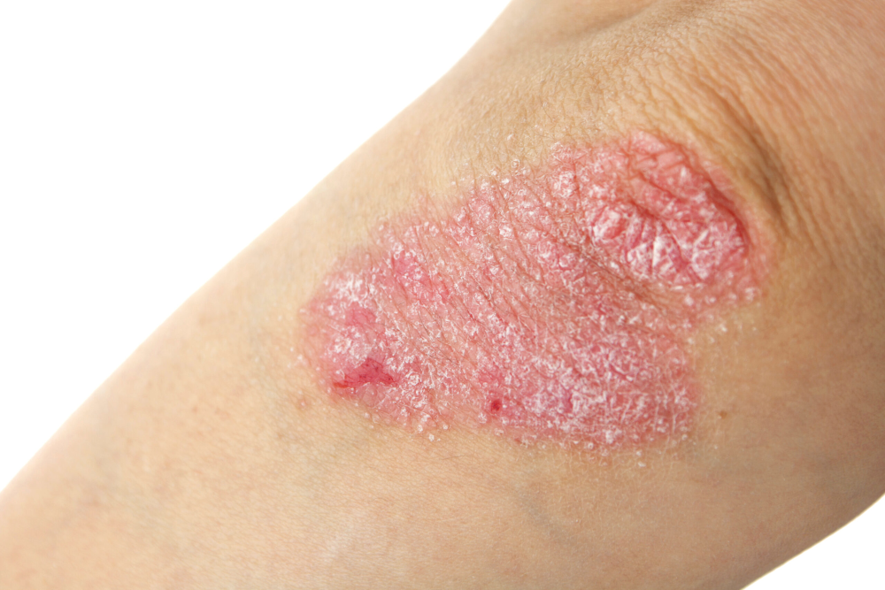 Psoriasis scaled 1 Trillium Clinic Dermatology Chapel Hill