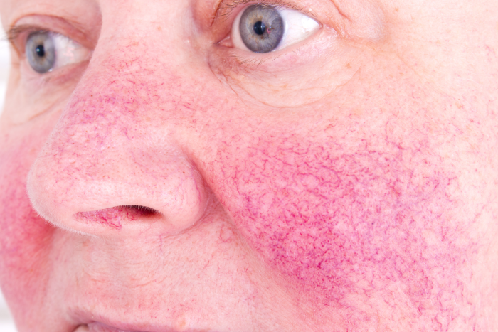 Rosacea what is Trillium Clinic Dermatology Chapel Hill