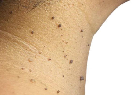 Skin Tags scaled 1 Trillium Clinic Dermatology Chapel Hill