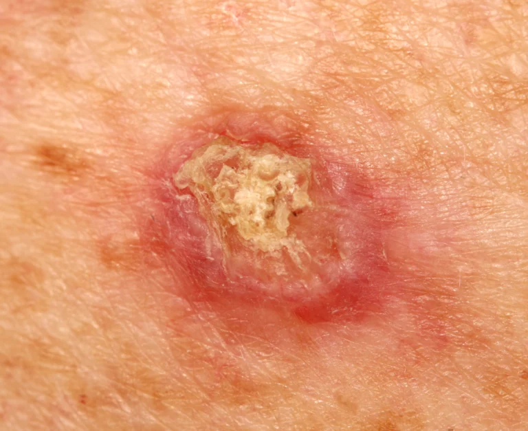 Squamous Cell Carcinoma