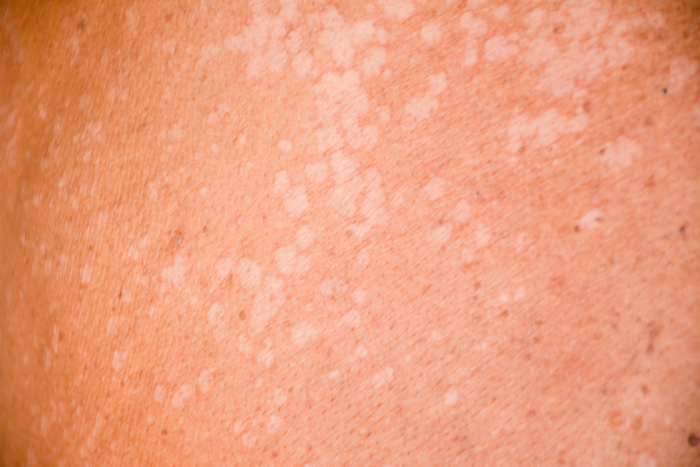 Tinea Versicolor what is Trillium Clinic Dermatology Chapel Hill