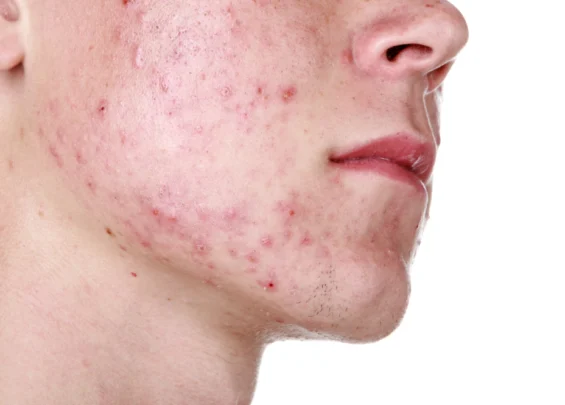 acne scaled 1 Trillium Clinic Dermatology Chapel Hill