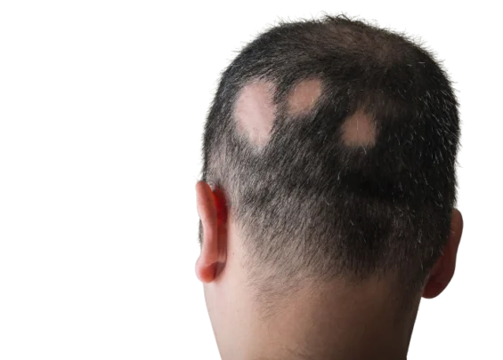 alopecia areata Trillium Clinic Dermatology Chapel Hill