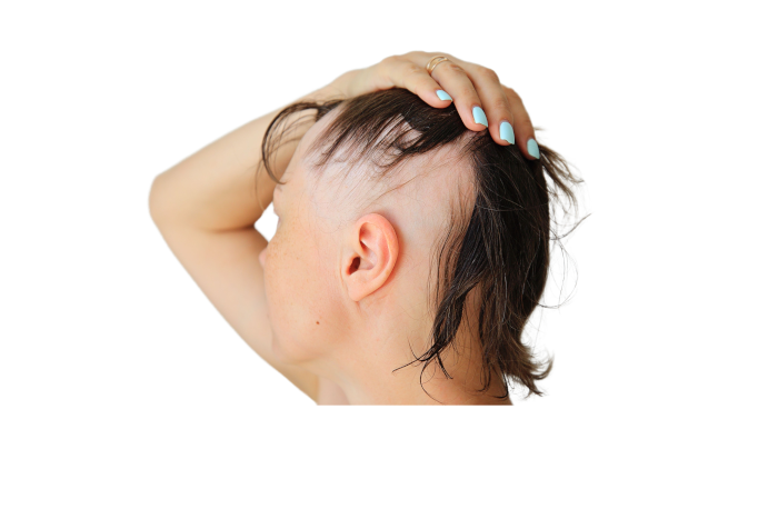 alopecia areata what is Trillium Clinic Dermatology Chapel Hill