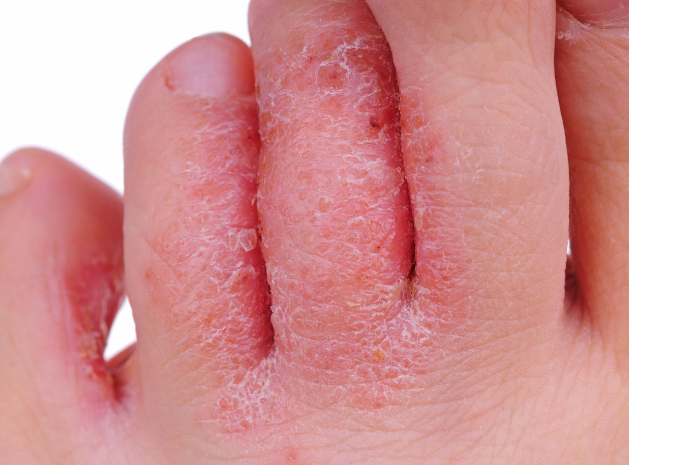 Tinea Pedis