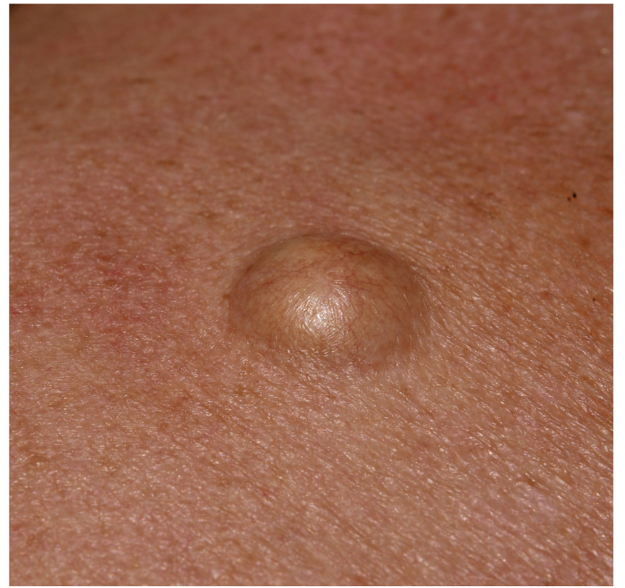 cyst what is Trillium Clinic Dermatology Chapel Hill