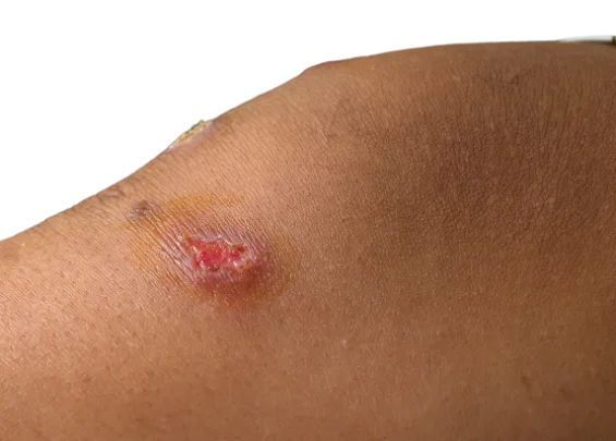 impetigo Trillium Clinic Dermatology Chapel Hill