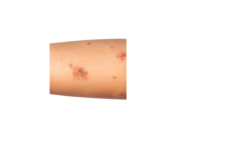 impetigo what is Trillium Clinic Dermatology Chapel Hill