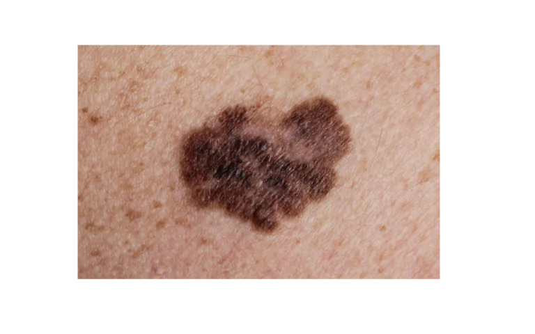 melanoma what is 1 Trillium Clinic Dermatology Chapel Hill