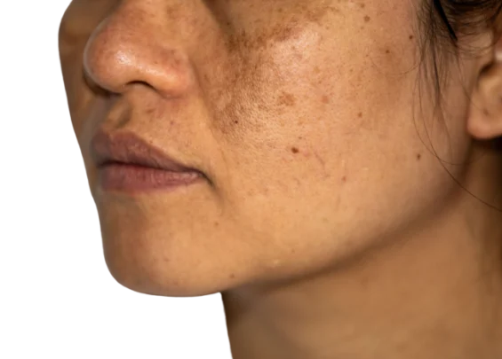 melasma Trillium Clinic Dermatology Chapel Hill