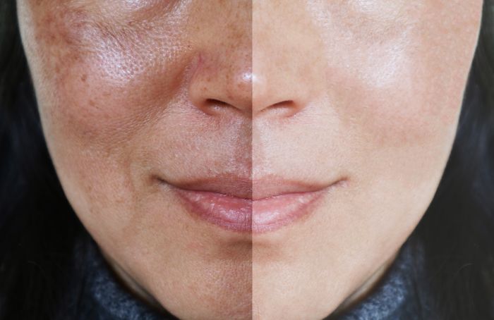 melasma what is Trillium Clinic Dermatology Chapel Hill