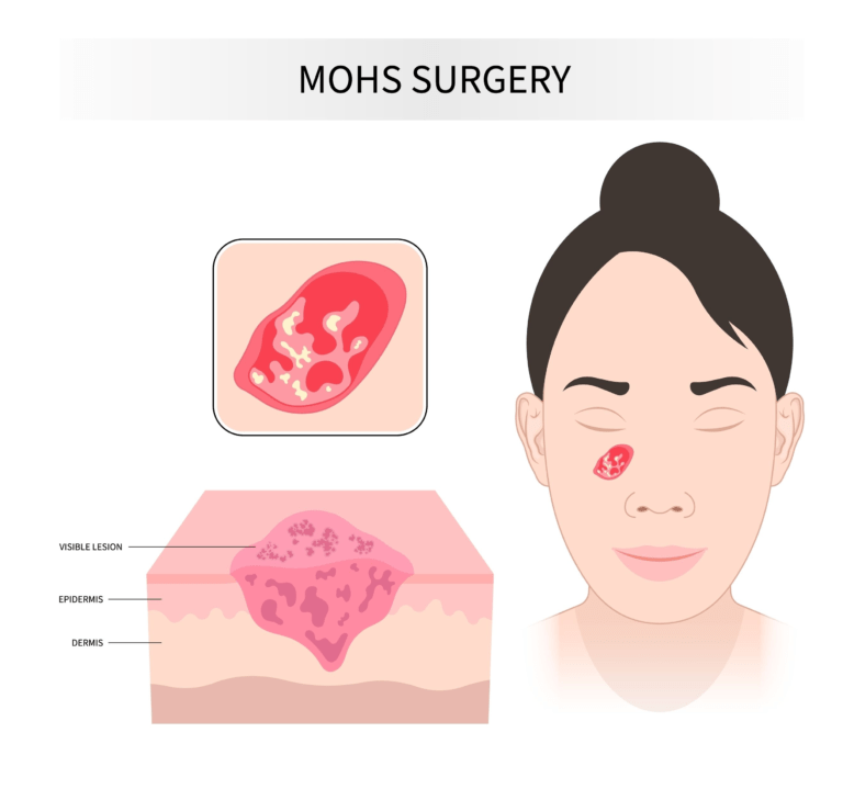 mohs surgery people choose e1721990946557 Trillium Clinic Dermatology Chapel Hill