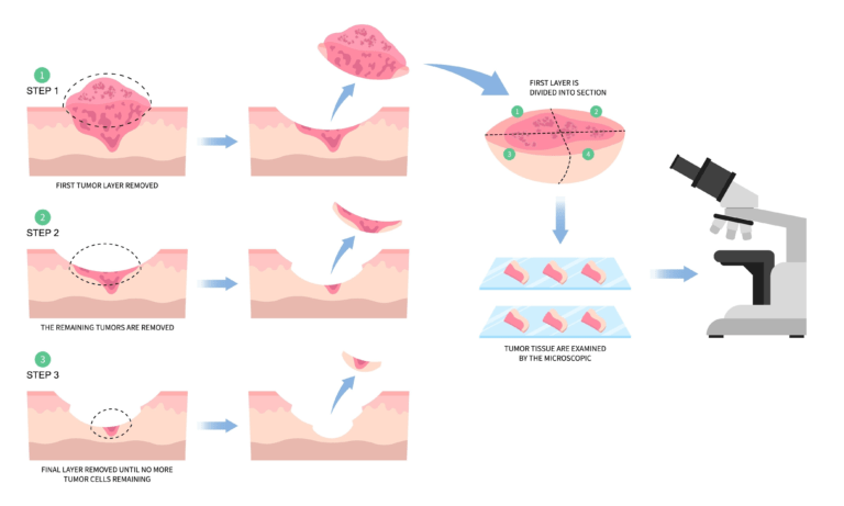 mohs surgery what is process e1721990737164 Trillium Clinic Dermatology Chapel Hill