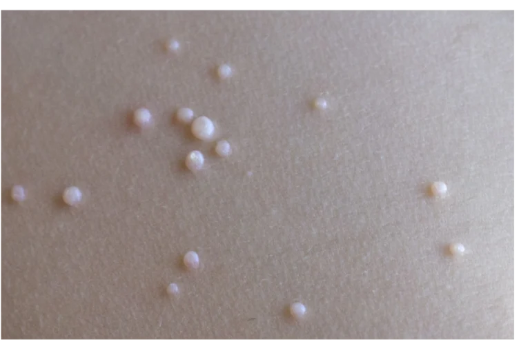 Molluscum Contagiosum