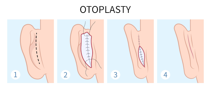 otoplasty3 Trillium Clinic Dermatology Chapel Hill