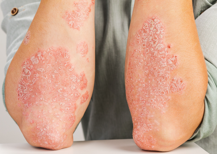 psoriasis what is Trillium Clinic Dermatology Chapel Hill