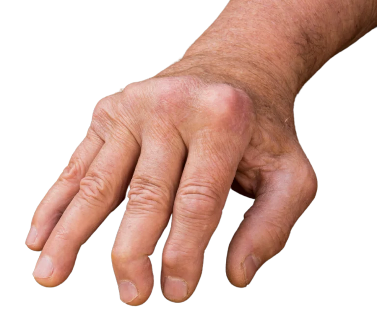 psoriatic arthritis what is Trillium Clinic Dermatology Chapel Hill