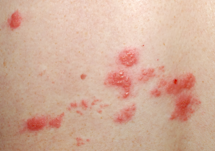 shingles what is Trillium Clinic Dermatology Chapel Hill