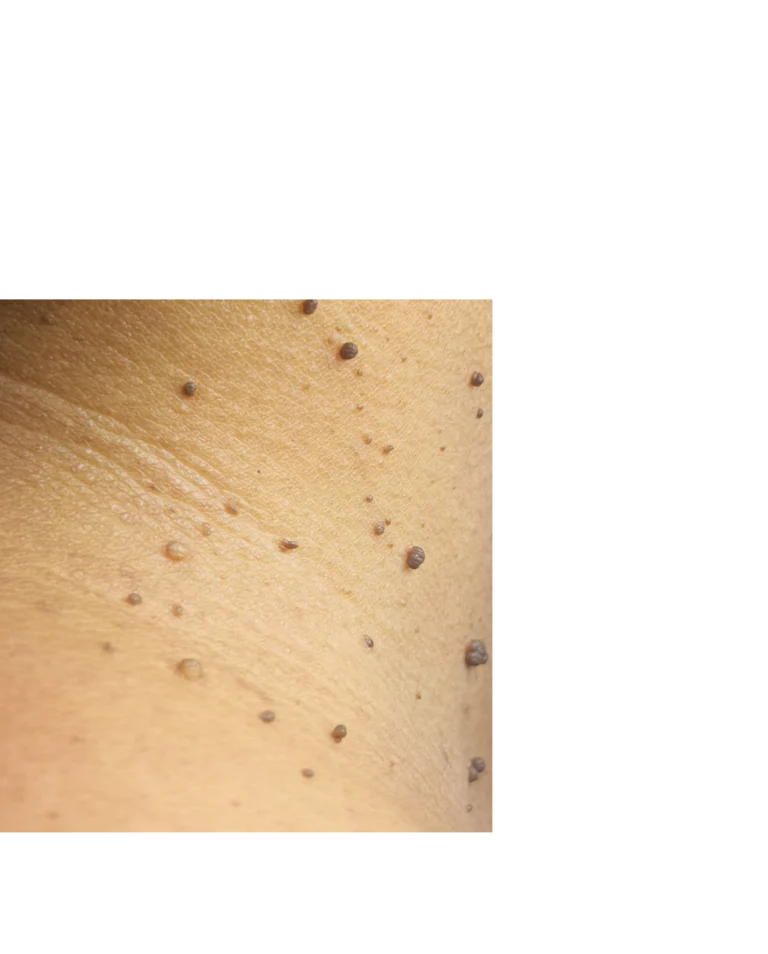 Skin Tags