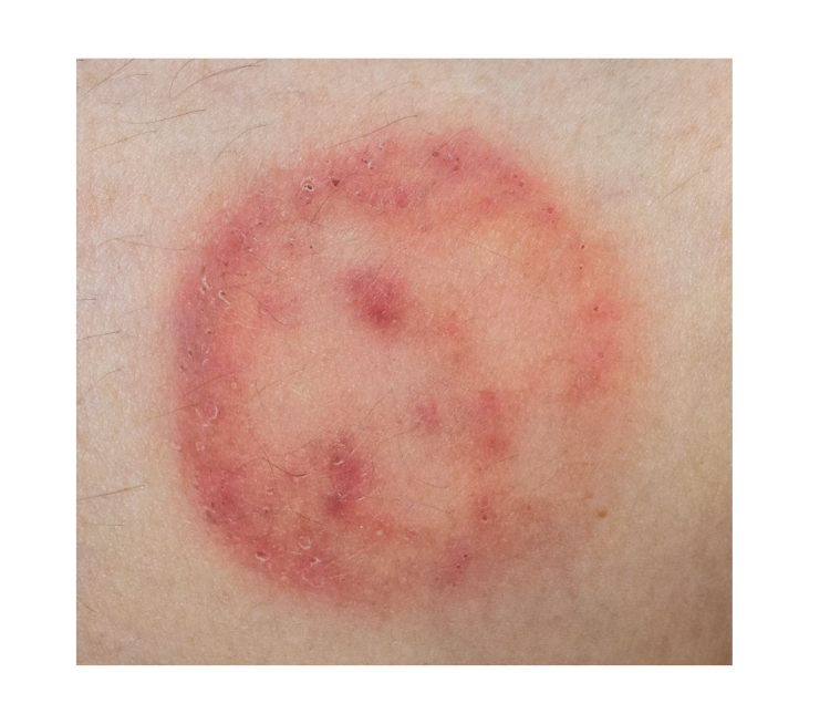 tinea corporis what is Trillium Clinic Dermatology Chapel Hill