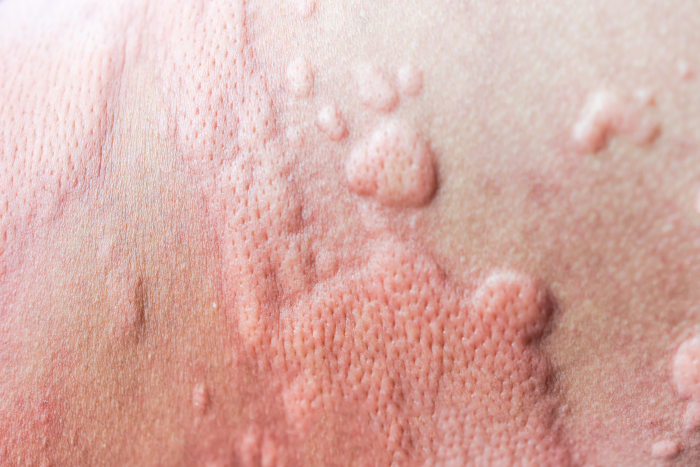 urticaria what is Trillium Clinic Dermatology Chapel Hill