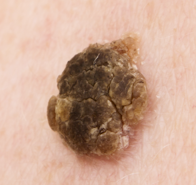 seborrheic keratosis what is Trillium Clinic Dermatology Chapel Hill