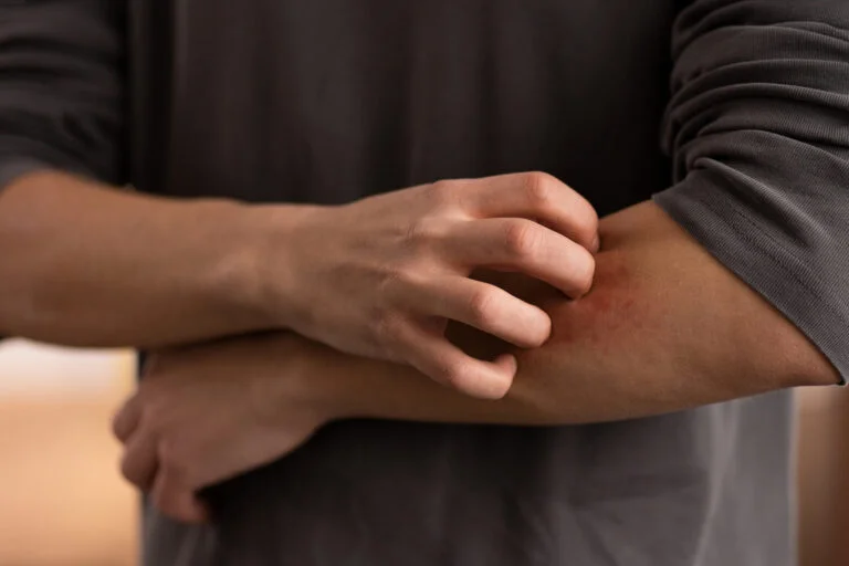 Understanding and Managing Itching: Causes, Treatments, and Tips for Relief