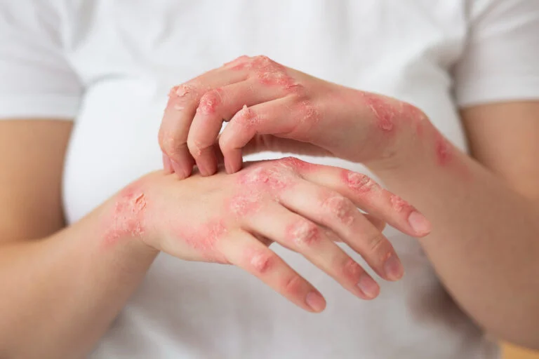 Understanding Psoriasis: Causes, Symptoms, and Treatment Options