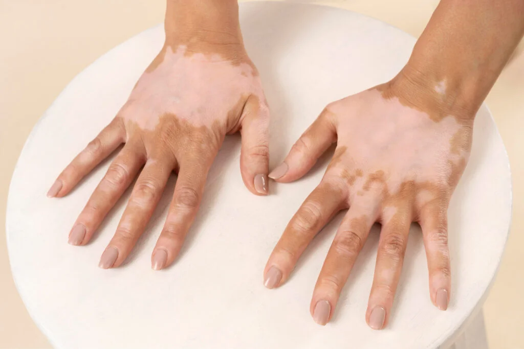 Advanced Vitiligo Treatments: A Comprehensive Guide to Innovative Solutions