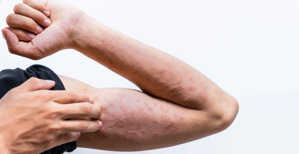 Eczema in Adults Trillium Clinic Dermatology Chapel Hill