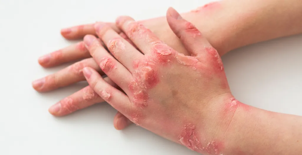 Psoriasis and Its Impact on Skin