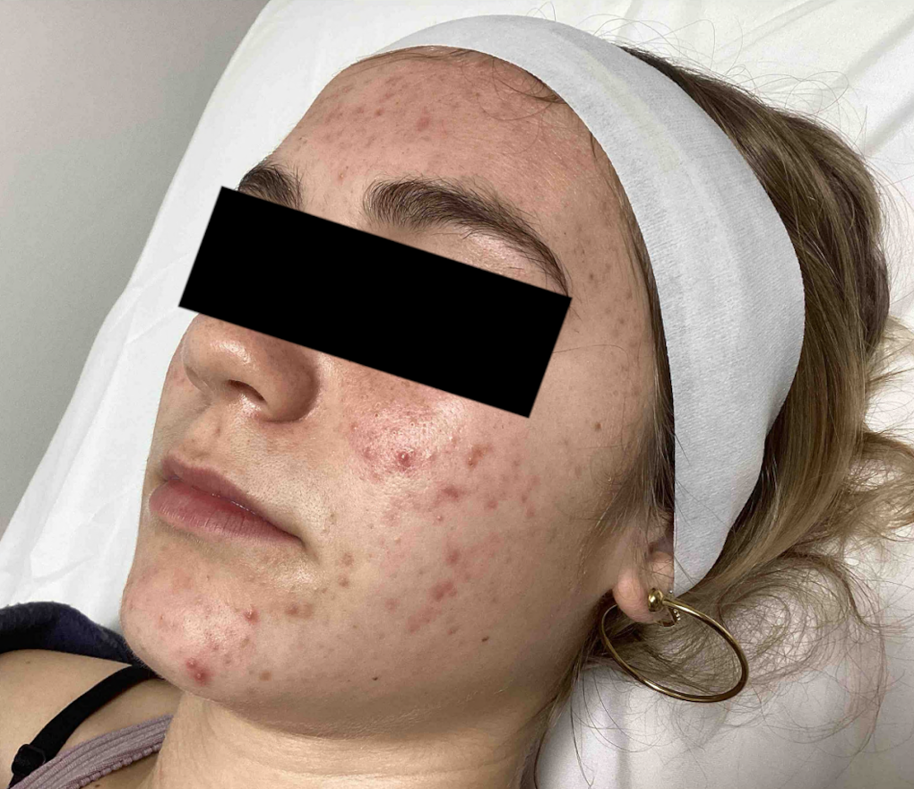 acne-before