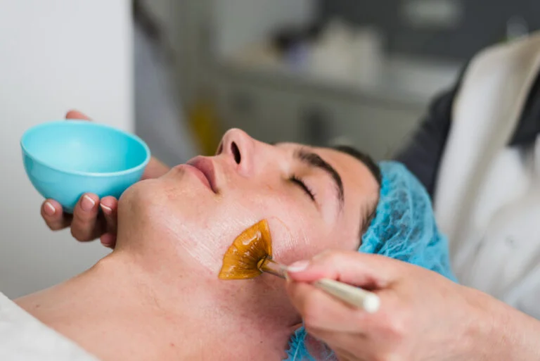 Chemical Peels for Acne