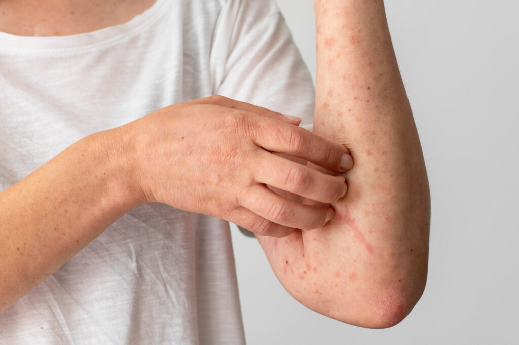 Hives (Urticaria): Causes, Symptoms, and Treatment Options