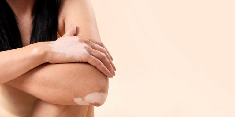 Vitiligo Treatment