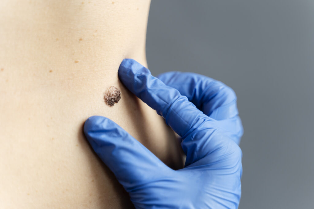 Wart Treatment in Chapel Hill & Burlington, NC Explained