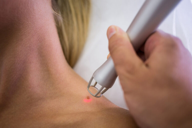 Laser Scar Revision: What Patients Should Know After Surgery