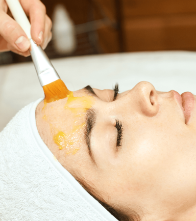 chemical peel