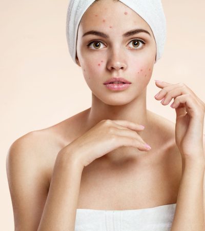 Scowling,Girl,In,Shock,Of,Her,Acne,With,A,Towel