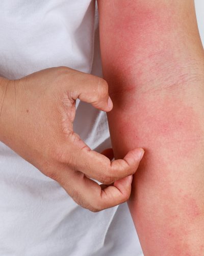 People,Scratch,The,Itch,With,Hand.,Allergic,Rash,Dermatitis,Eczema