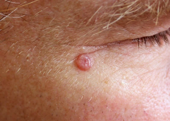 Basal Cell Carcinoma