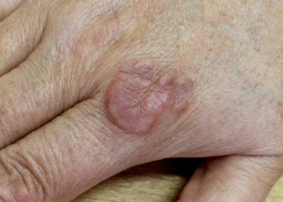 Granuloma Annulare scaled 1 qoajnt7ezf6gfh1dsm9a15u9n0dklddgvslhcrvbig Trillium Clinic Dermatology Chapel Hill