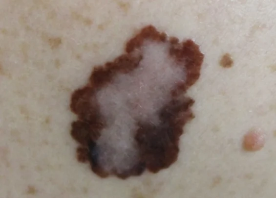 Melanoma 1 scaled 1 qoajnt7ezf6gfh1dsm9a15u9n0dklddgvslhcrvbig Trillium Clinic Dermatology Chapel Hill